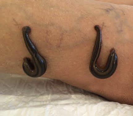 Leech-Therapy